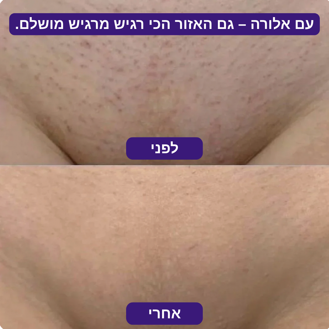 מסיר השיער של - ™Alora