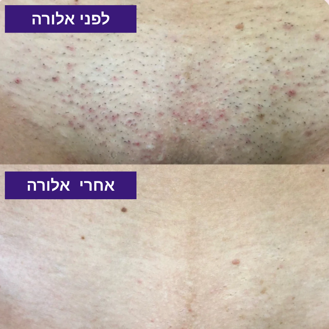 מסיר השיער של - ™Alora