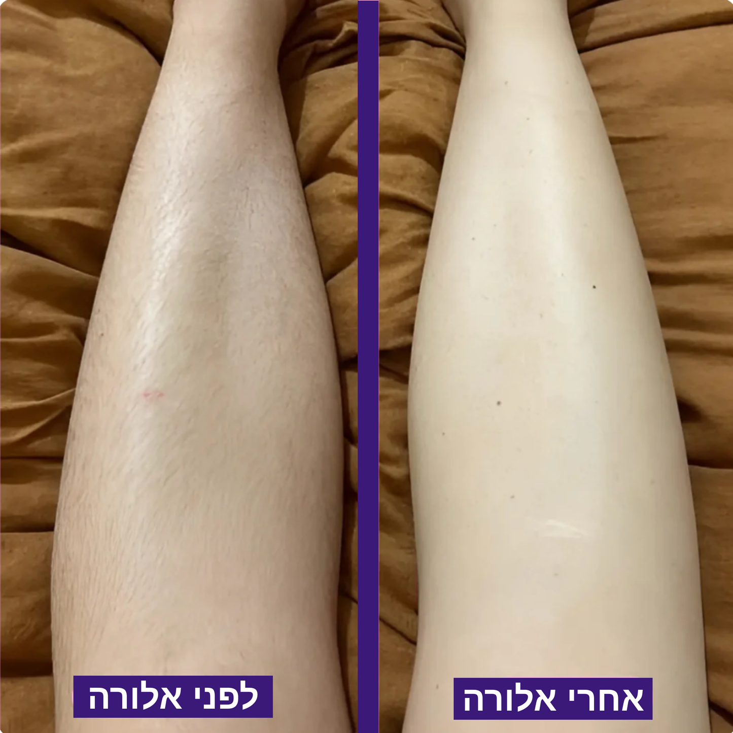 מסיר השיער של - ™Alora