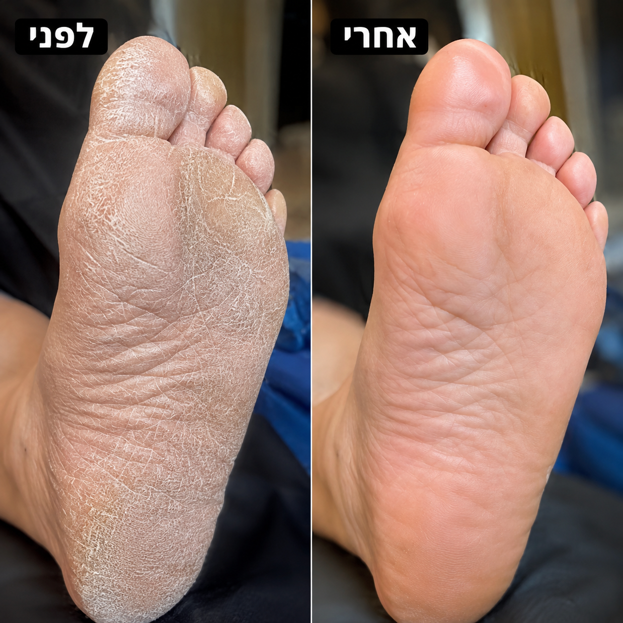 מכשיר הפדיקור הביתי להסרת עור יבש, סדקים וחספוס ALORA™