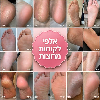 מכשיר הפדיקור הביתי להסרת עור יבש, סדקים וחספוס ALORA™