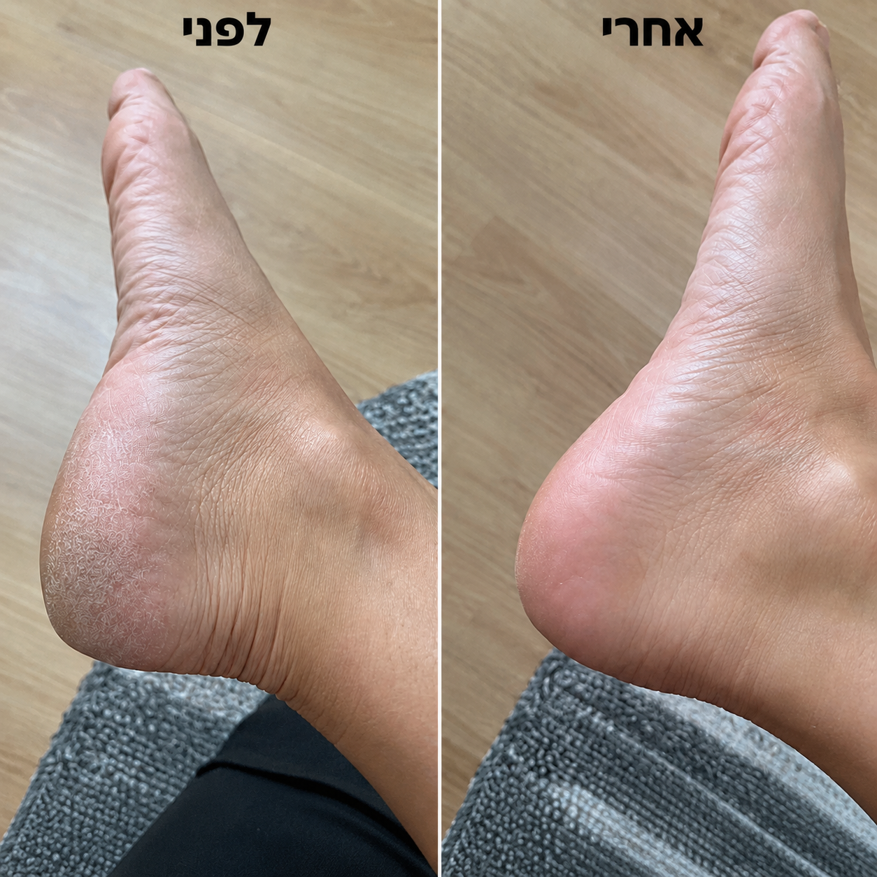 מכשיר הפדיקור הביתי להסרת עור יבש, סדקים וחספוס ALORA™