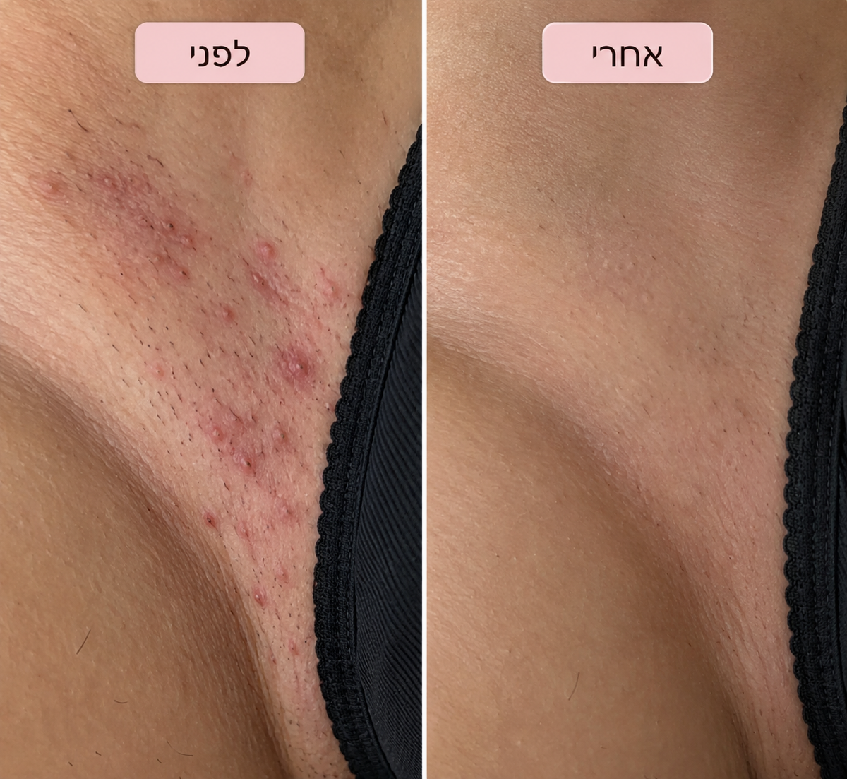 סכין גילוח למניעת גירוי, פצעים ושיער חודרני של ALORA™