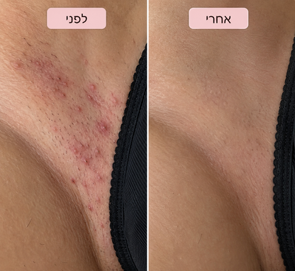 סכין גילוח למניעת גירוי, פצעים ושיער חודרני של ALORA™