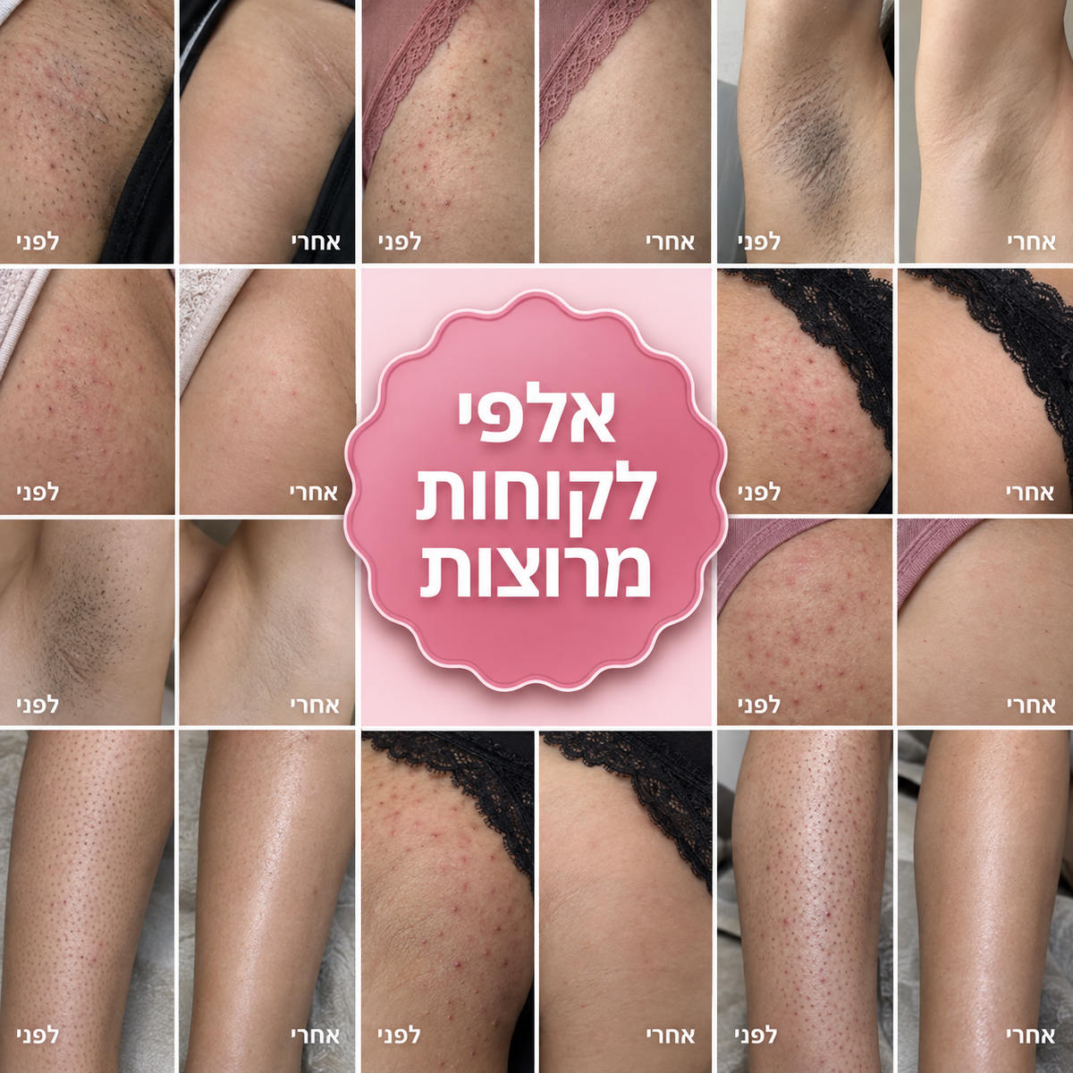 סכין גילוח למניעת גירוי, פצעים ושיער חודרני של ALORA™