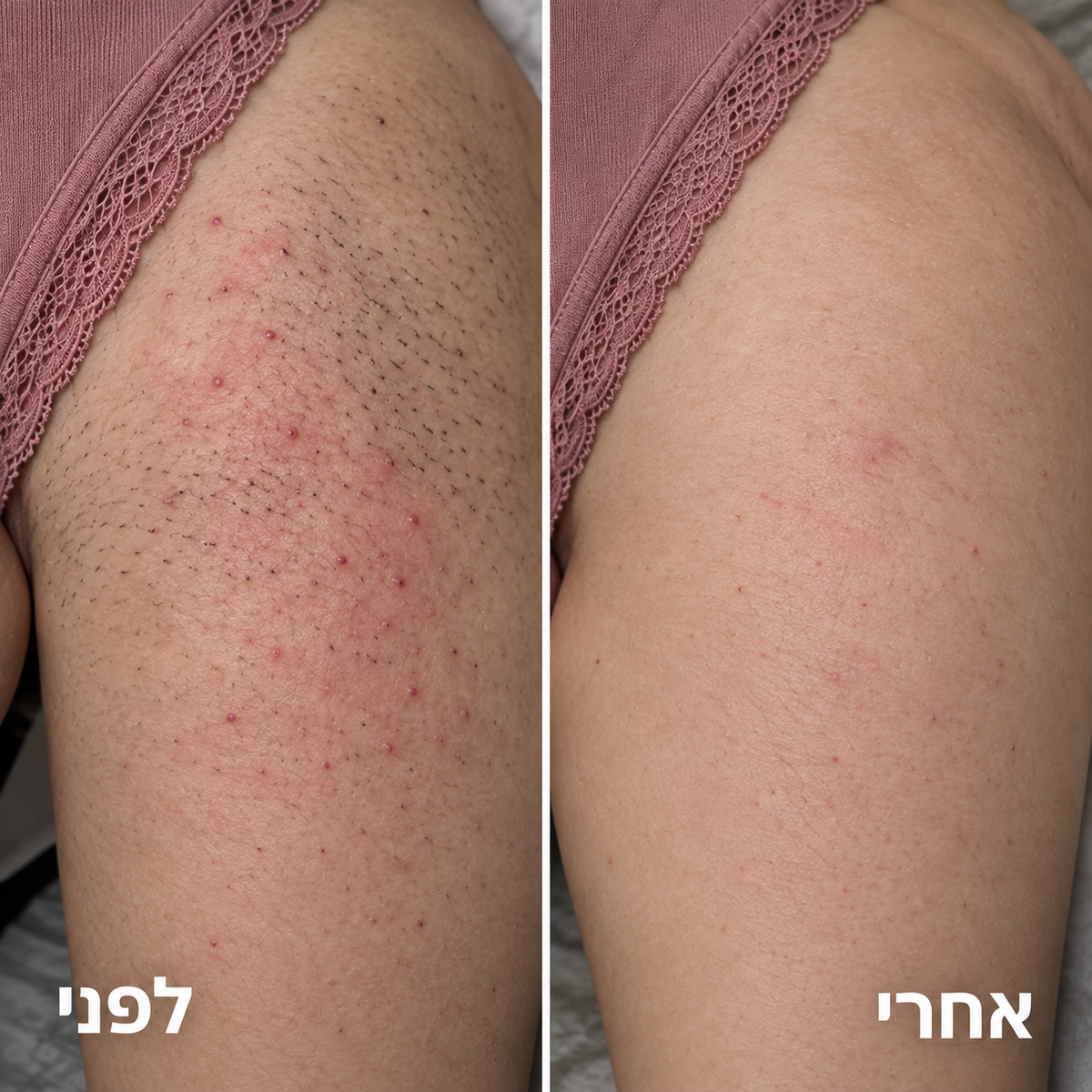 סכין גילוח למניעת גירוי, פצעים ושיער חודרני של ALORA™