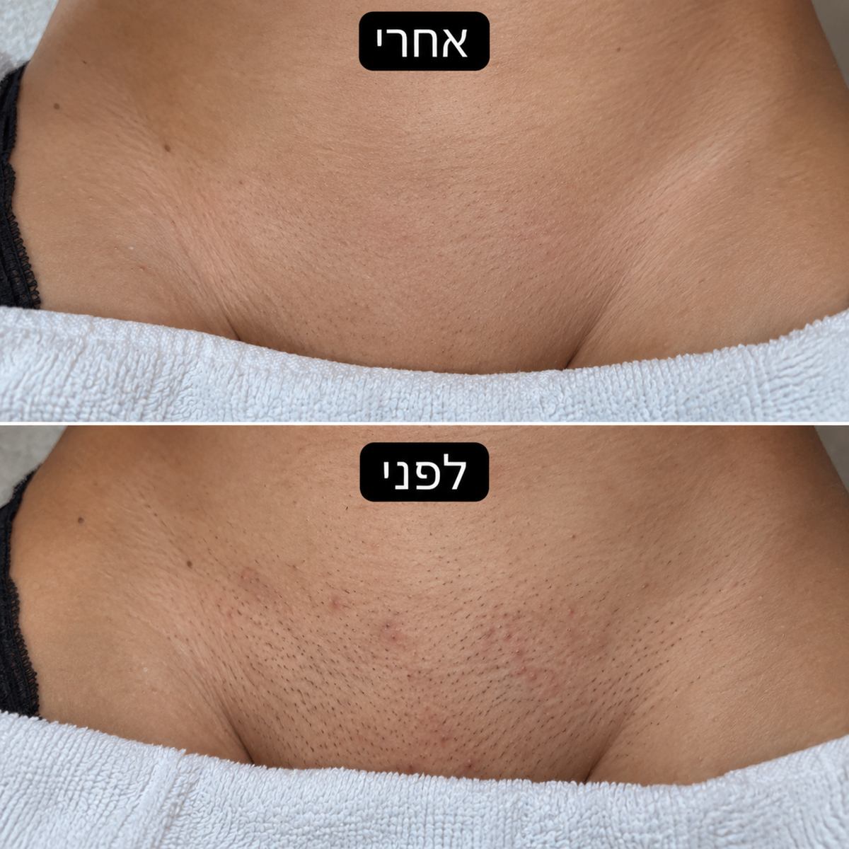 סכין גילוח למניעת גירוי, פצעים ושיער חודרני של ALORA™